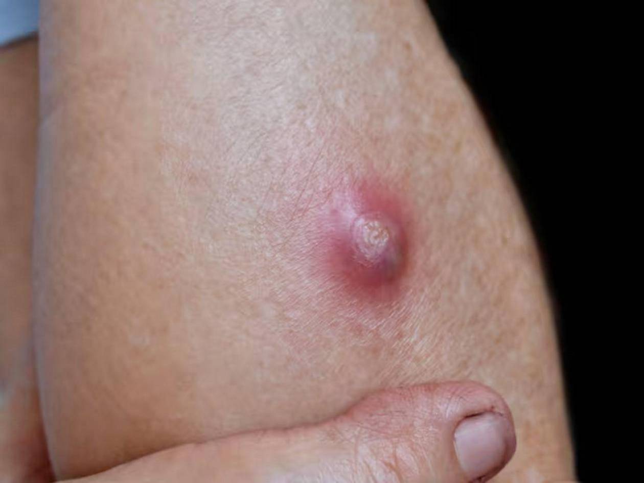 Devorador de hombres, así invade y prolifera en heridas humanas el gusano barrenador