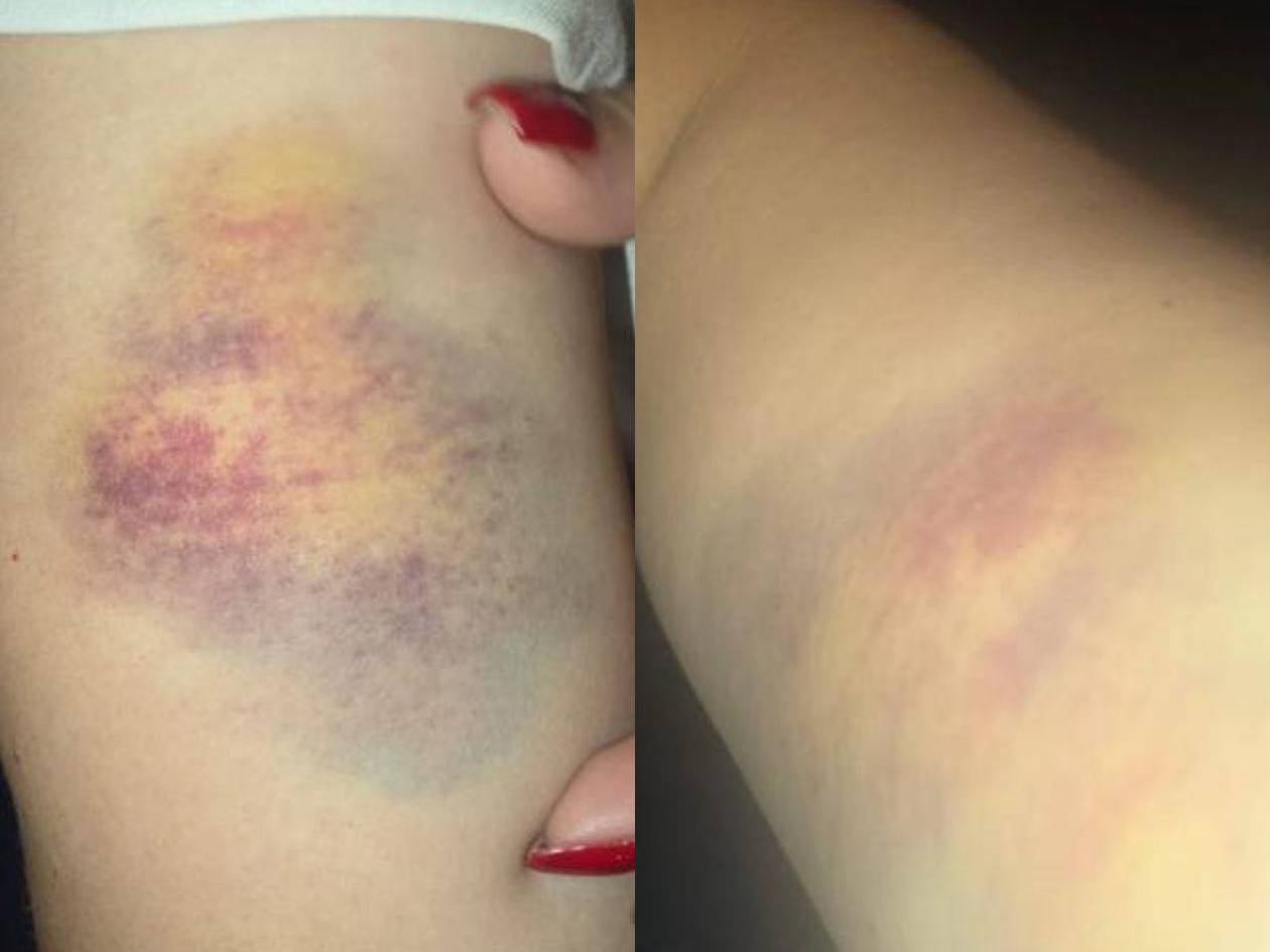 Kathia Krivelli muestra moretes tras denunciar agresiones de Bartolo Fuentes