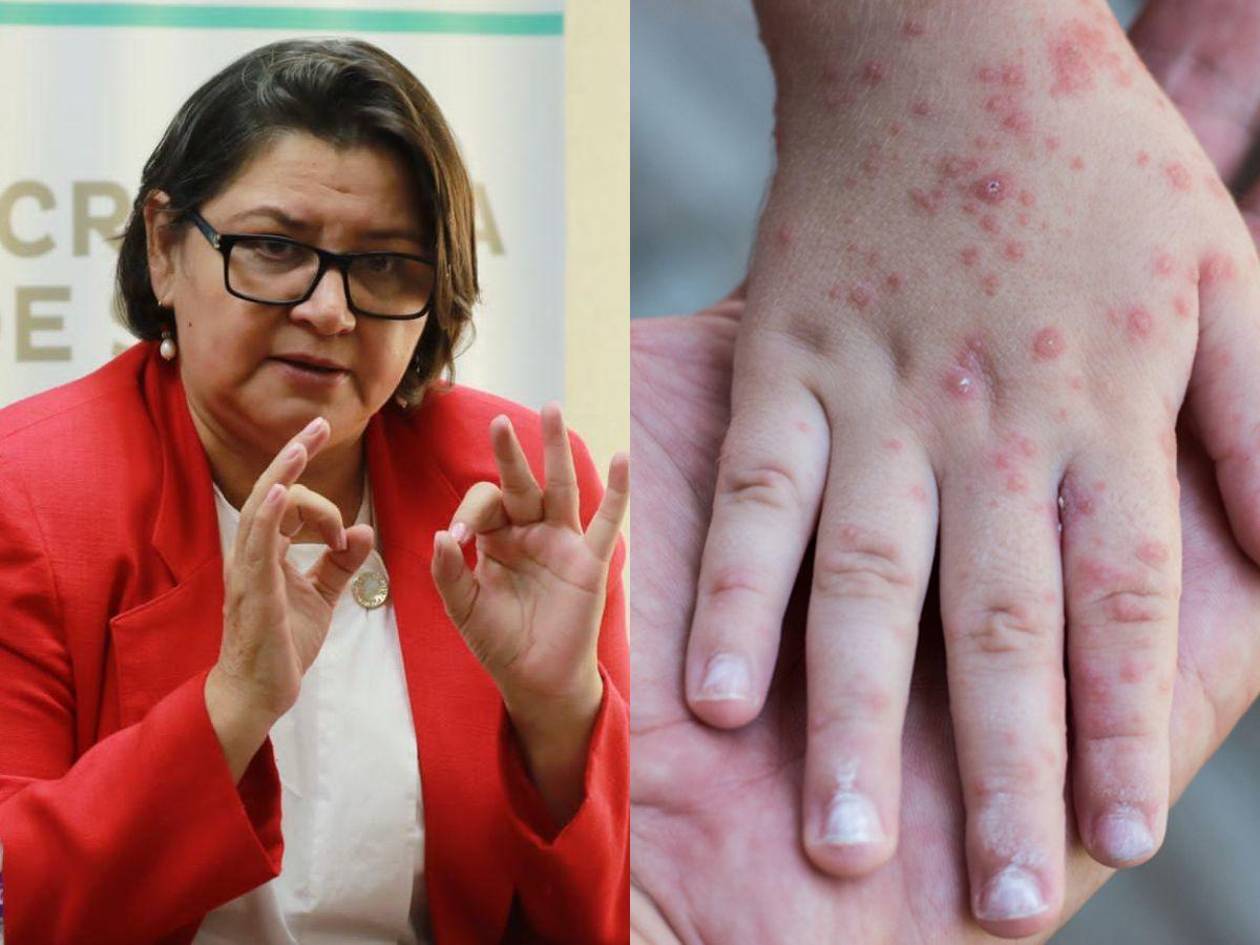 Laboratorios privados no están autorizados para hacer pruebas de sarampión, asegura ministra de Salud