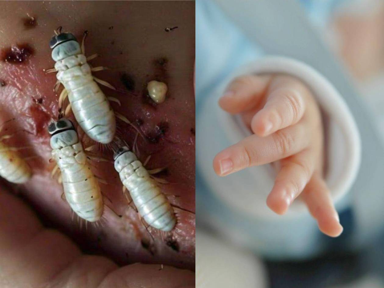 Bebé de 19 días lucha por su vida tras sufrir miasis umbilical por gusano barrenador