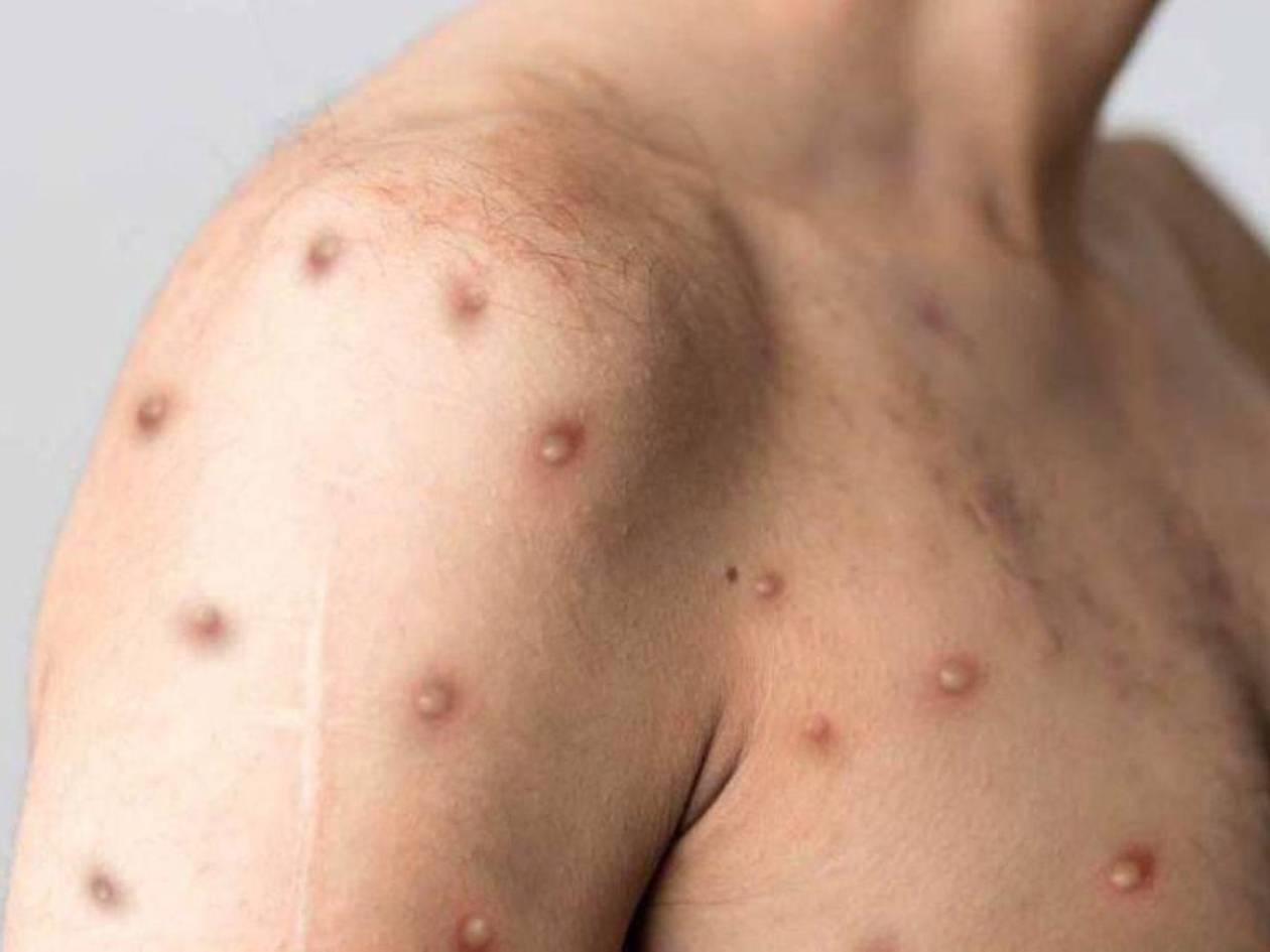 Confirman tres casos de viruela del mono en Honduras en una semana