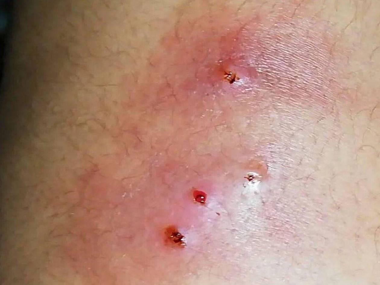 Paciente con miasis por gusano barrenador en Estados Unidos venía de El Salvador