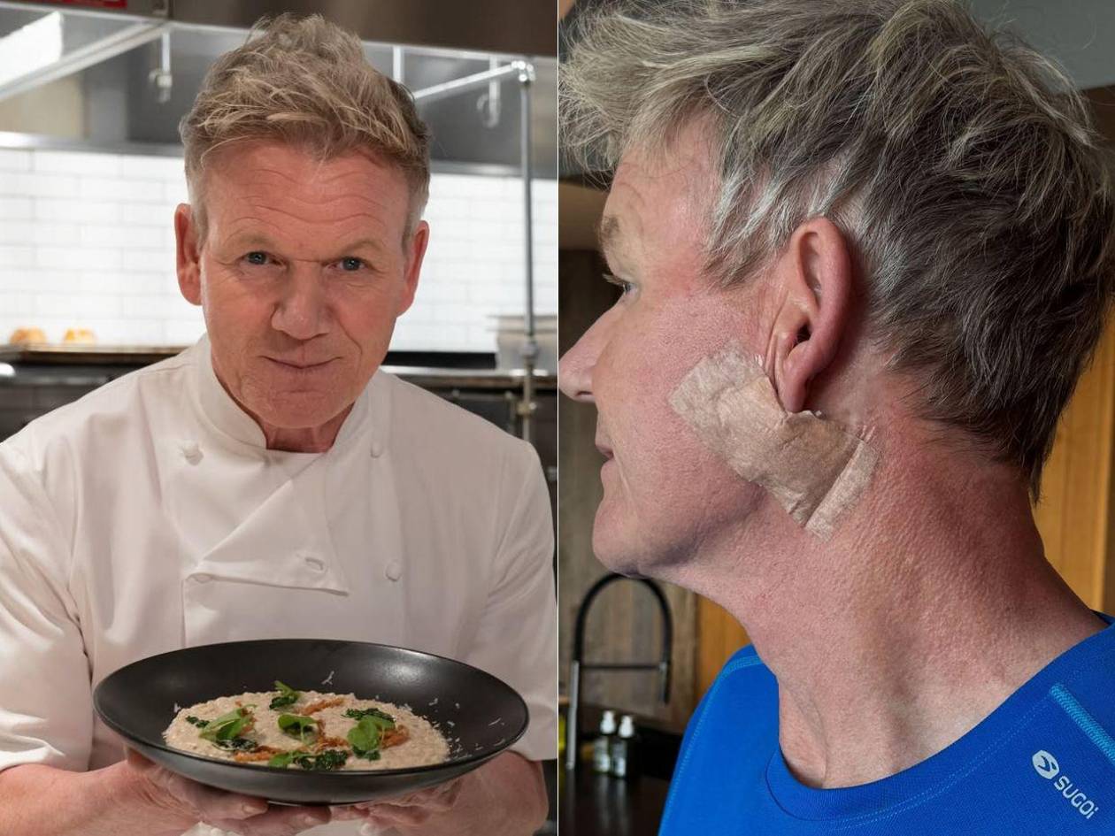 “No es un lifting”: Gordon Ramsay explica las cicatrices de su cirugía por cáncer de piel