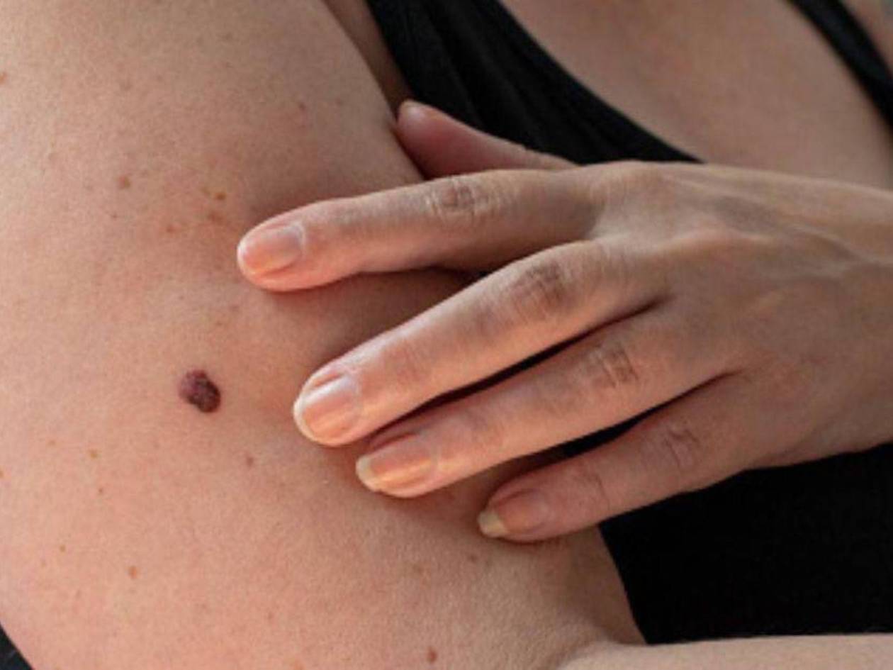 Al menos 52 casos sospechosos de cáncer de piel se detectan en el Hospital Escuela