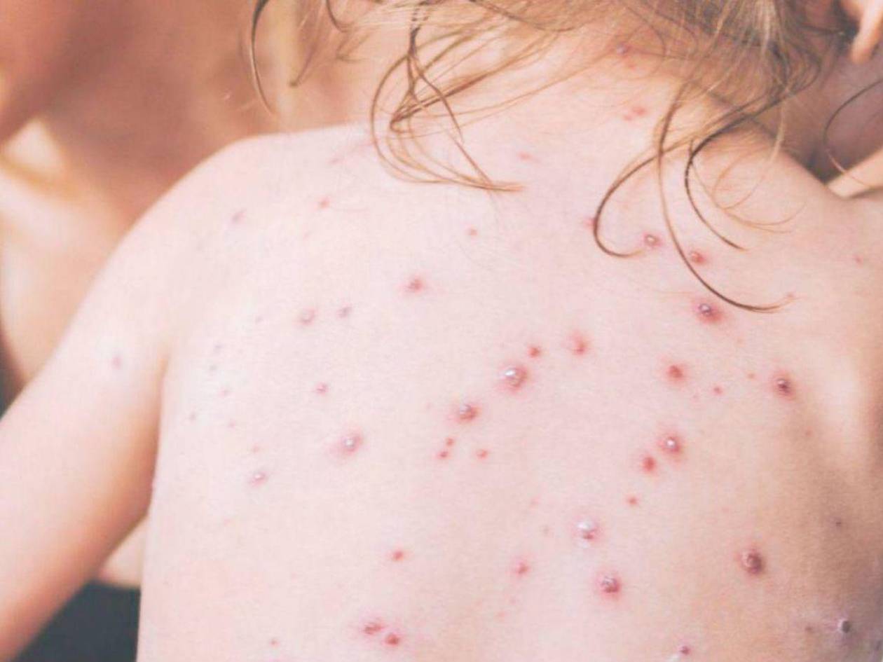 Honduras en alerta máxima por riesgo de propagación del sarampión