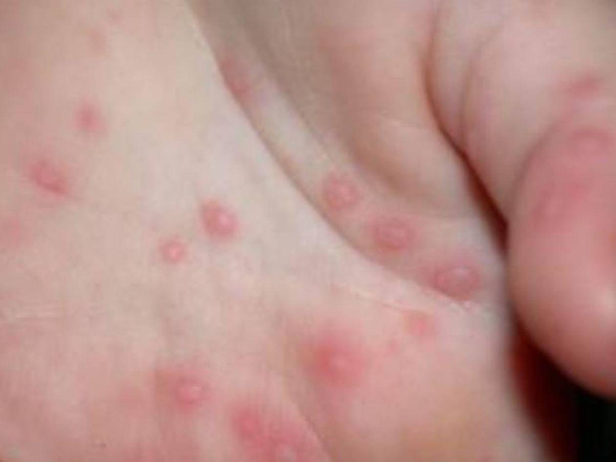 ¿Qué es la enfermedad Boca, mano y pie o virus Coxsackie, que afecta escuelas de México?