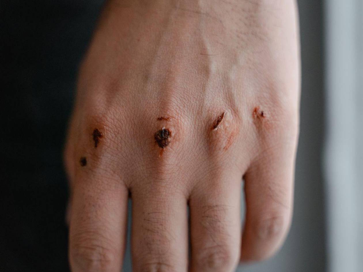 Devorador de hombres, así invade y prolifera en heridas humanas el gusano barrenador