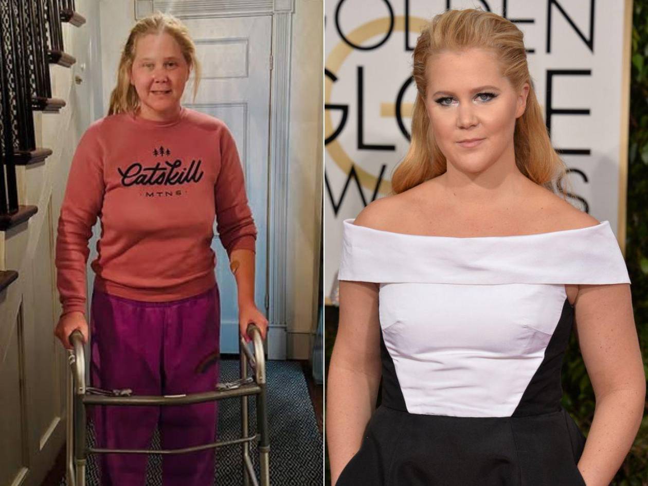 ¿Qué llevó a Amy Schumer a pasar por una cirugía de columna?