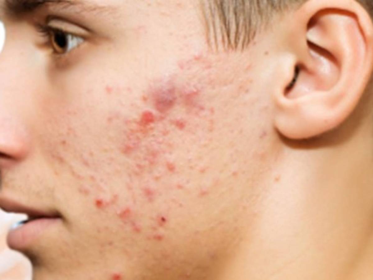 Remedios caseros para curar el acné