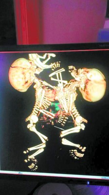 Madre hondureña pide ayuda para siamesas