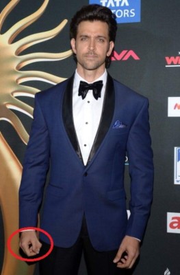 Fotogalería: Los defectos físicos más sorprendentes de los famosos