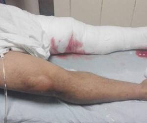 Nohemy Milla recibió un balazo en su pierna izquierda.