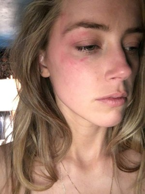 Amber Heard muestra golpes en su rostro