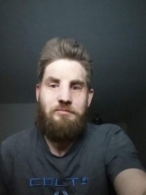 FOTOS: El increíble trasplante de rostro de un soldado