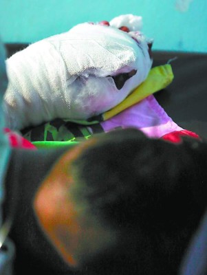 Potente mortero cercena tres dedos a menor de 11 años en Siguatepeque