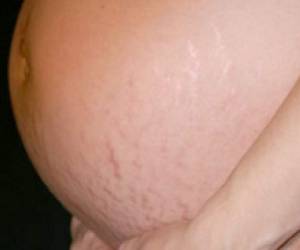 Las estrías son producto del estiramiento agresivo de la piel.