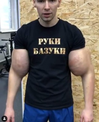 El antes y después del 'Popeye' que se inyectó aceite en los músculos