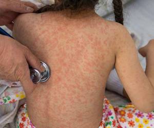 <b>La Secretaría de Salud activó un cerco epidemiológico en Cortés tras confirmar el caso 13 de sarampión, correspondiente a un bebé de seis meses que se recupera en condición estable.</b>
