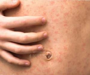 Las autoridades de Salud informaron que los sospechosos están bajo vigilancia médica.