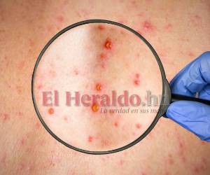 Después de varios días sin registrarse casos, este martes se detectaron dos nuevos.