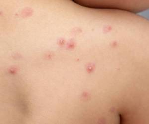 Los tres pacientes reportados en el país por viruela símica se mantienen bajo vigilancia médica y en condiciones estables de salud.