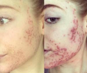 Sufre terribles brotes de acné. Foto Instagram
