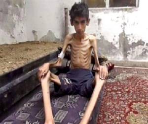 Las imagenes desgarradoras de la población que se esta mueriendo por la falta de comida, han tenido que comer perros y gatos.(Foto AP)