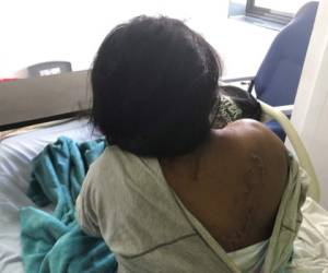 Dina Blanco muestra heridas en su espalda durante una entrevista en el hospital Luis Fabrega en Santiago, Panamá. Foto: AP.