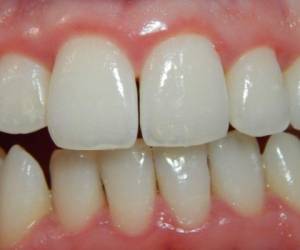 Usar el hilo dental con frecuencia ayudará a evitar la gingivitis.