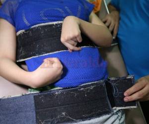 El Aedes aegypti transmite el virus del zika, la cual está relacionada con el trastorno neurológico.