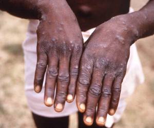 Un simple caso de viruela del mono en un país no endémico es considerado como un brote, afirma la OMS