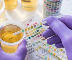 Las personas con cáncer de vejiga y daltonismo poseían un 52% más de posibilidades de morir en los 20 años posteriores al diagnóstico.