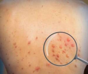 México confirmó el 28 de mayo su primer caso importado de viruela del mono en un estadounidense de 50 años.