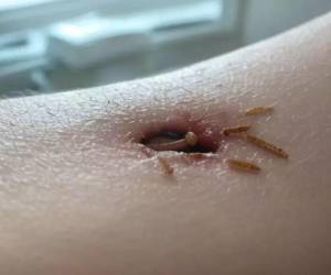 Las autoridades sanitarias aconsejan a la población a cubrirse las heridas abiertas para evitar que la mosca deje sus huevecillos y éstos se conviertan en larvas que se alimentan del tejido vivo.