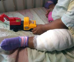 En lo que va del 2025, el Centro Hondureño para el Niño Quemado registra la atención de 450 menores con quemaduras, por diferentes causas.