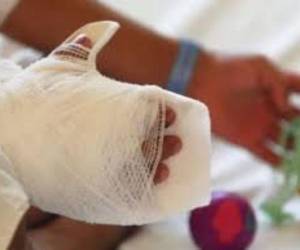 Con un 98% de ocupación hospitalaria, las emergencias de niños quemados han sido atendidas.