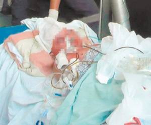 El costo de un tratamiento por quemaduras de pólvora es variable, según el caso, sin embargo ronda los 25 mil lempiras diarios.