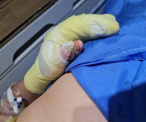 Personal médico del hospital Mario Catarino Rivas atiende a pacientes con quemaduras provocadas por pólvora durante las festividades navideñas.