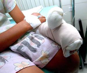 Según las autoridades de distintos centros médicos, el uso de la pólvora pesada fue un factor determinante para el ingreso e incluso amputación parcial en las manos de 5 menores de edad.