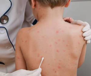 Los menores que aún ni reciben la vacuna son los más afectados por la enfermedad, indicaron las autoridades.