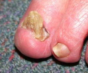 La onicogrifosis tiene mayor incidencia en el dedo gordo del pie y presenta una textura muy dura y crecimiento descontinuo de la uña. FOTO CORTESÍA: Dermatly