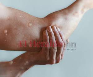 Las erupciones cutáneas también forman parte de los síntomas de la viruela del mono.