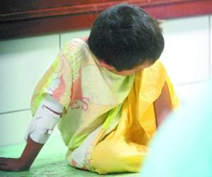 El niño de 10 años que tiene quemado el 90% de su cuerpo llegó el fin de semana al centro asistencial.