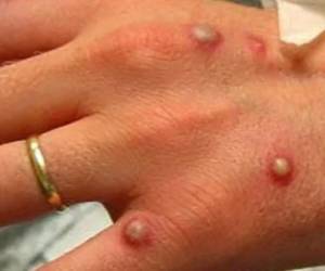 La viruela del mono u “ortopoxvirosis simia” es una enfermedad considerada rara y menos peligrosa y contagiosa que la viruela.