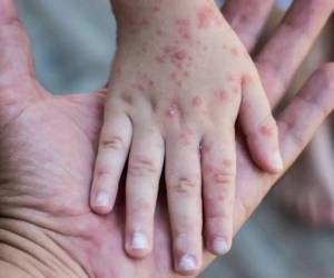 La alerta indica que los menores de cinco años, específicamente los menores de un año son los más vulnerables ante la enfermedad.