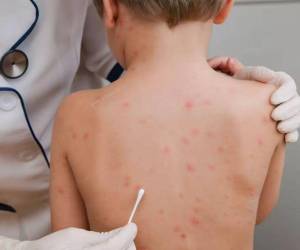 Actualmente las autoridades de la Secretaría de Salud confirman 12 casos de sarampión, de los cuales cuatro son menores de edad.