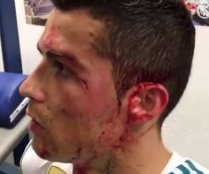 La herida de Cristiano Ronaldo que sufrió en el duelo ante el Deportivo La Coruña.