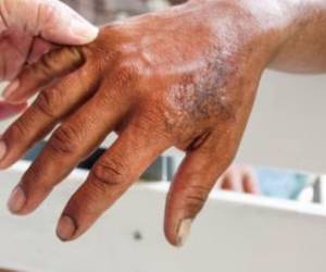 Uno de los síntomas de la enfermedad son las lesiones en la piel.