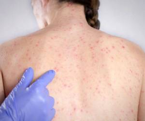 Las autoridades sanitarias recomiendan a la población que al presentar síntomas como fiebre alta, tos seca, erupción de manchas rojas en la piel acudan a los establecimientos de salud.