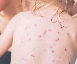 La paciente que reside en Corinto, Omoa tiene nexo epidemiológico con la situación de la enfermedad que esta afectando en Guatemala.
